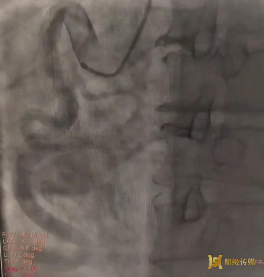 常德二医收治首例冠脉异常起源罕见病例