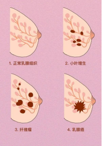 乳腺微创旋切术——小切口解决大问题，让您去“瘤”无痕