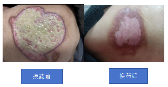 【卓越护理】伤口换药的新选择——互联网+护理服务