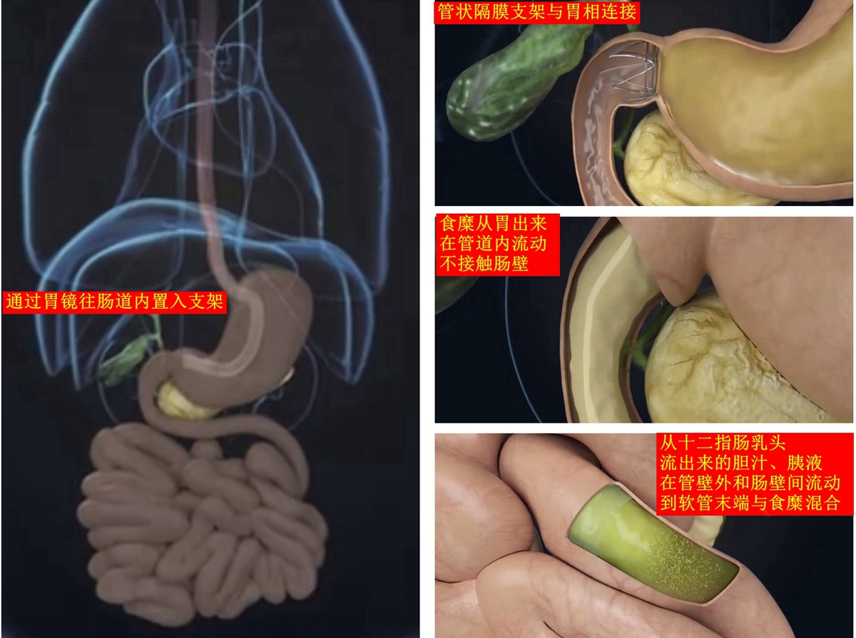 3个月平均减重20%！肠道里放支架！常德一医实施湘西北首例内镜下减重术