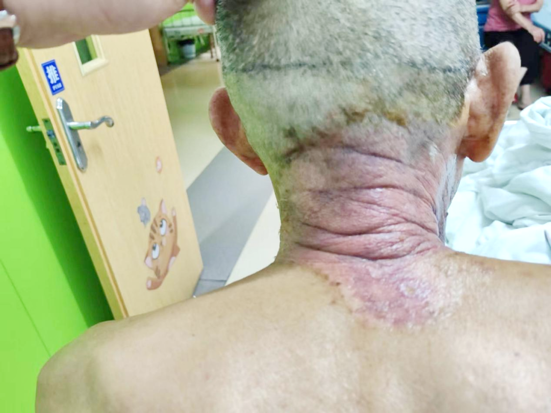 带状疱疹到底有多痛？