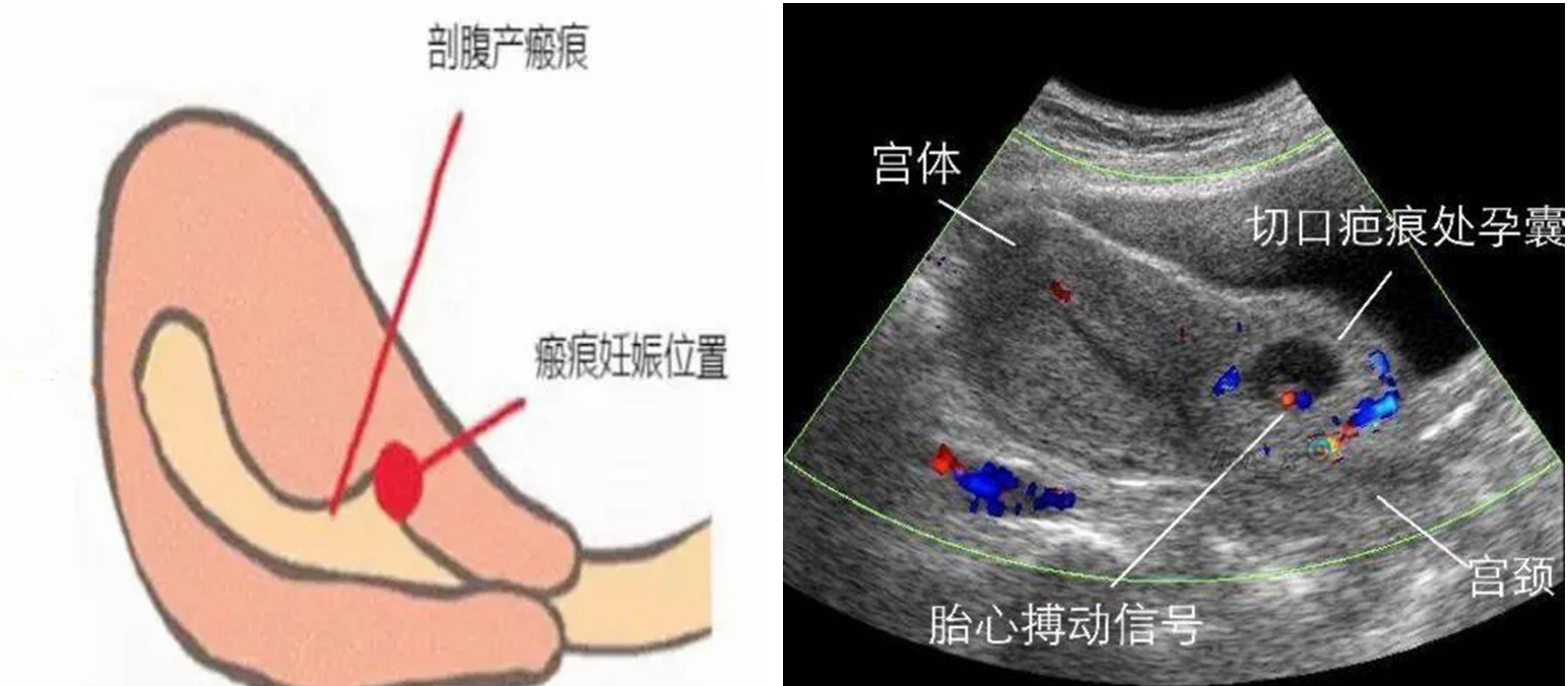 巧拆子宫上的“隐形炸弹”——常德一医开展新技术救治瘢痕妊娠患者