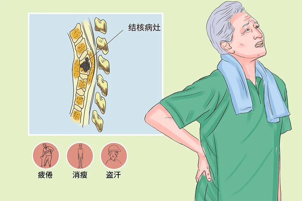 “镜”显优势——常德市第四人民医院疼痛科成熟运用脊柱内镜技术精准治疗早期腰椎结核