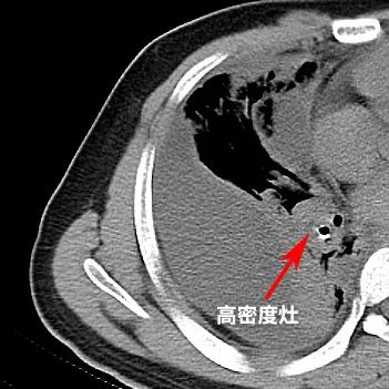 20岁男子发烧咳嗽久治不愈，竟因圆珠笔帽“潜伏”身体十余年……
