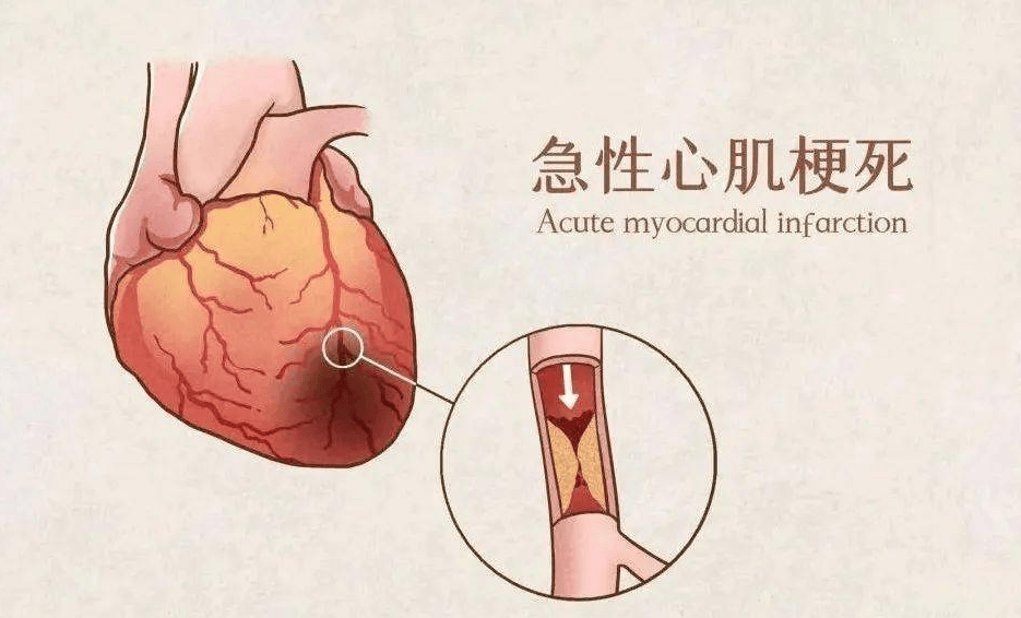 常德市第四人民医院：急性心肌梗死小知识