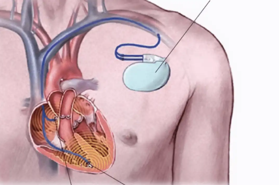 常德市第四人民医院: 揭开心脏起搏器的神秘面纱，重启生命律动!