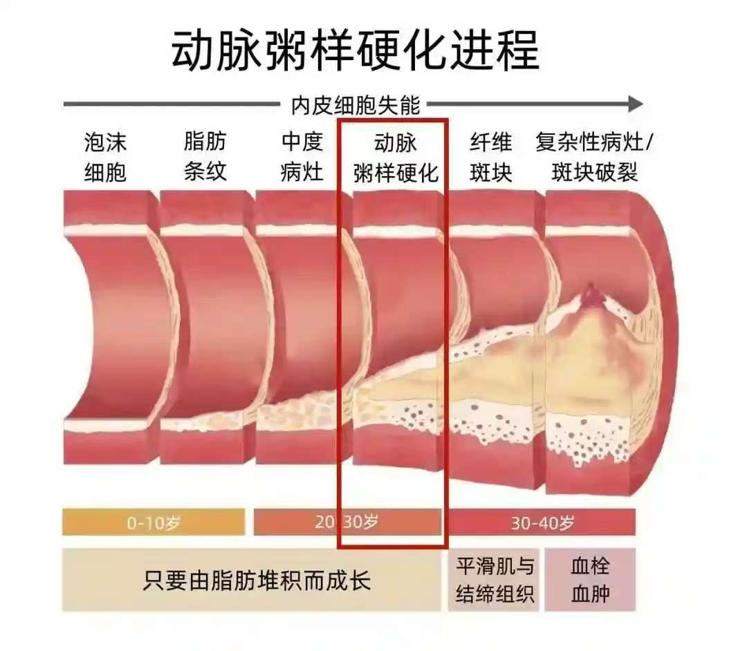 常德市第四人民医院：揭开脑动脉硬化的神秘面纱
