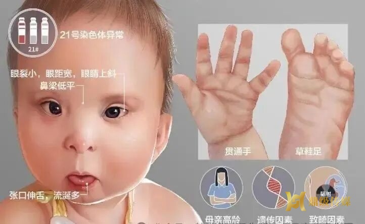 【鼎城妇幼科普】3·21世界唐氏综合征日｜科学筛查守护健康，共同对抗孤独