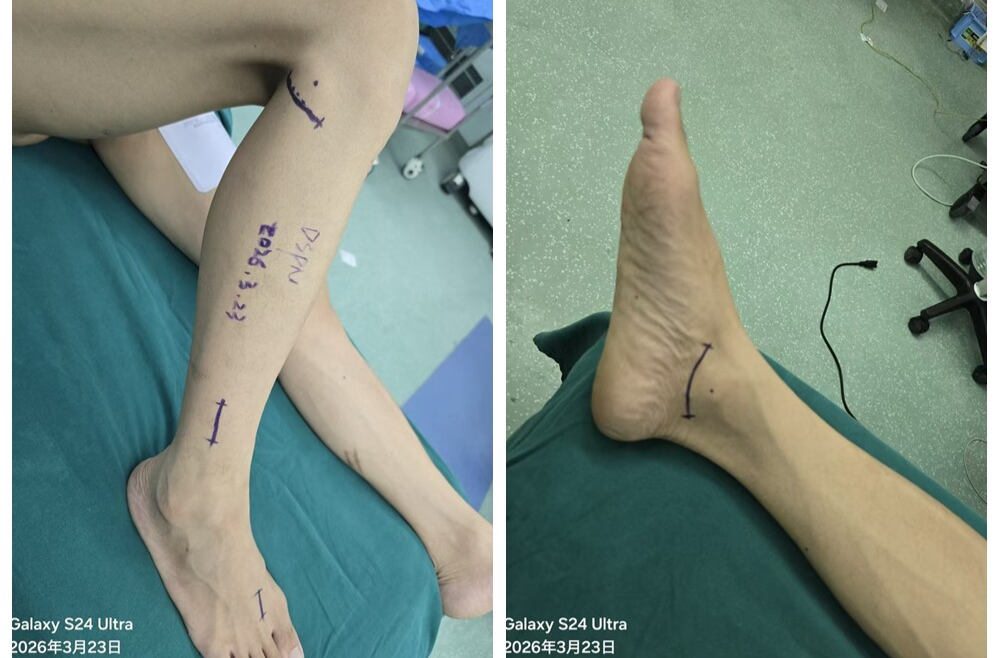 糖尿病下肢疼痛束手无策？常德一医这项微创手术让患者摆脱止痛药