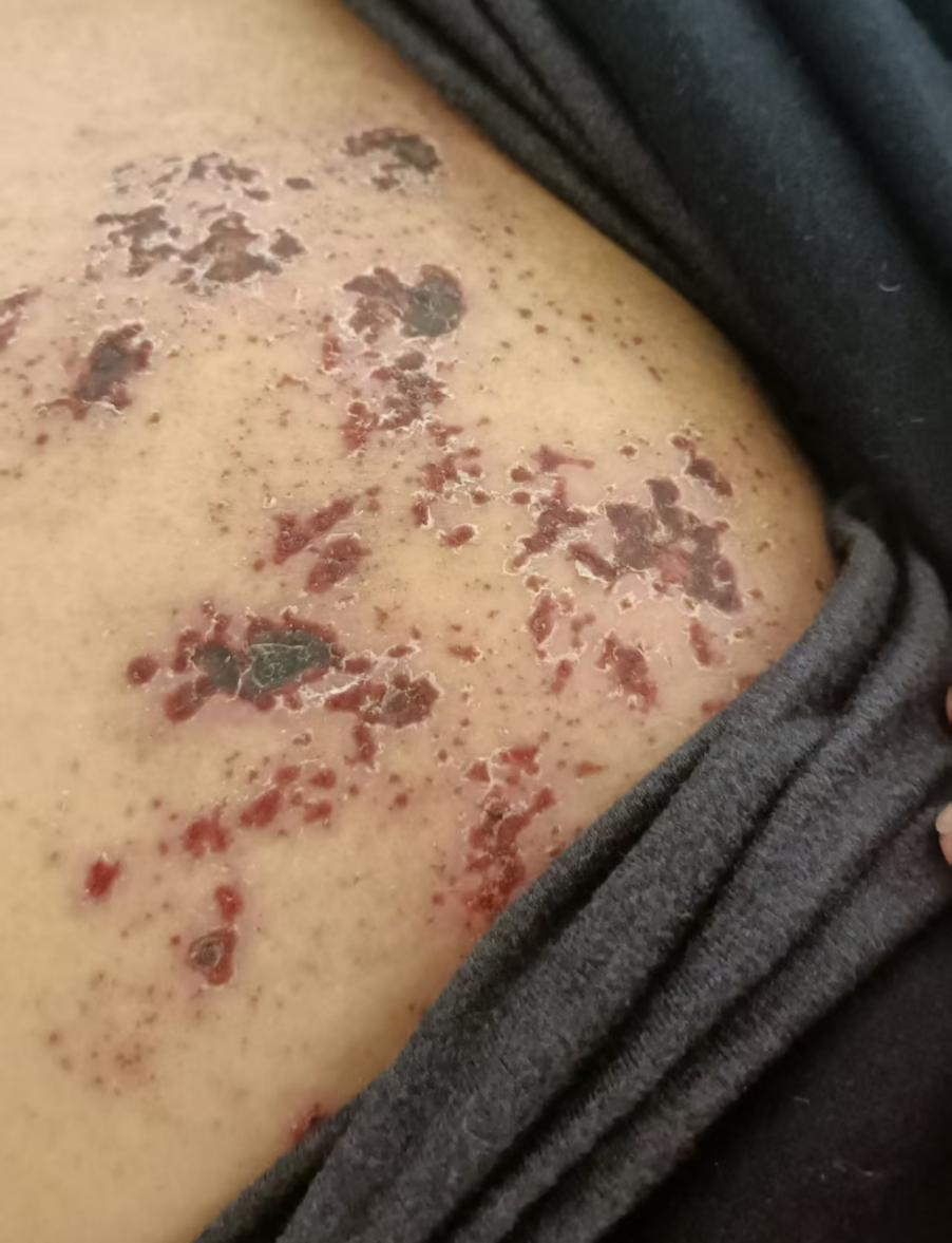 75岁爷爷被“蛇缠腰”痛到崩溃，常德市第四人民医院一根细针“关掉”疼痛信号