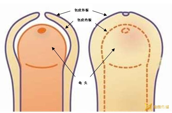 鼎城妇幼资讯：黄金暑期，科学“解包袱” 抓住孩子包皮手术最佳恢复期