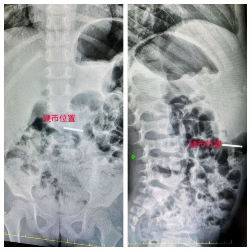 【健康科普】孩子误吞硬币千万别乱抠！错误急救会致命