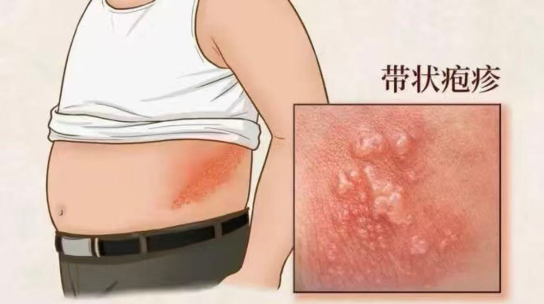 常德市第四人民医院：蛇缠腰走了，痛却留下了，这种痛到底是怎么回事？